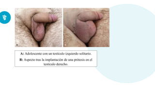 A: Adolescente con un testículo izquierdo solitario.
B: Aspecto tras la implantación de una prótesis en el
testículo derecho.
 