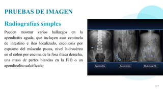 PRUEBAS DE IMAGEN
Radiografías simples
Pueden mostrar varios hallazgos en la
apendicitis aguda, que incluyen asas centinela
de intestino e íleo localizado, escoliosis por
espasmo del músculo psoas, nivel hidroaéreo
en el colon por encima de la fosa ilíaca derecha,
una masa de partes blandas en la FID o un
apendicolito calcificado
3 7
 
