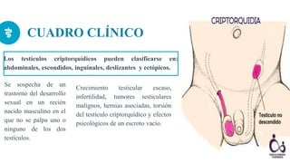Los testículos criptorquídicos pueden clasificarse en:
abdominales, escondidos, inguinales, deslizantes y ectópicos.
CUADRO CLÍNICO
Se sospecha de un
trastorno del desarrollo
sexual en un recién
nacido masculino en el
que no se palpa uno o
ninguno de los dos
testículos.
9
Crecimiento testicular escaso,
infertilidad, tumores testiculares
malignos, hernias asociadas, torsión
del testículo criptorquídico y efectos
psicológicos de un escroto vacío.
 
