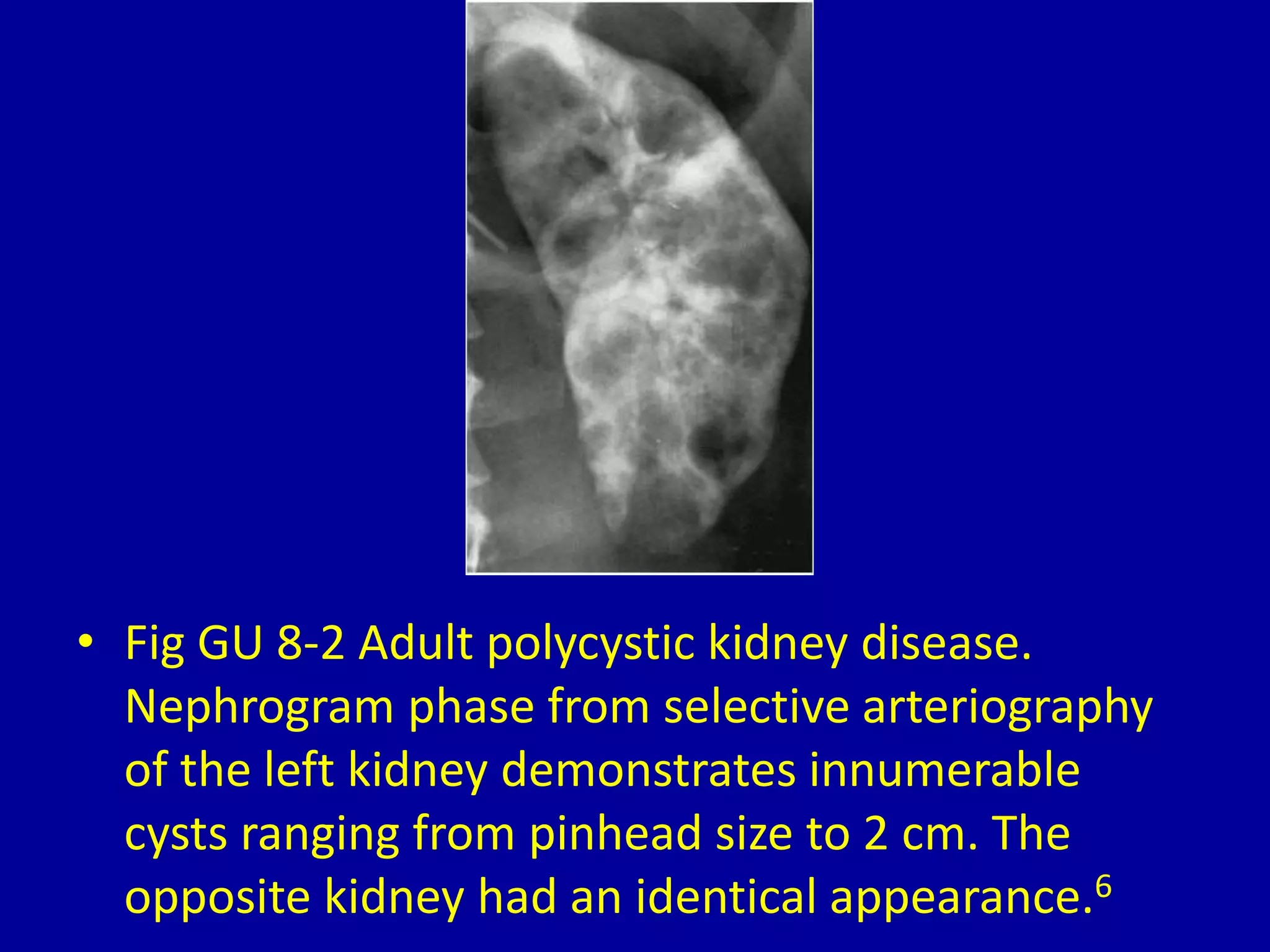 8 bilateral large, multifocal kidneys | PPTX