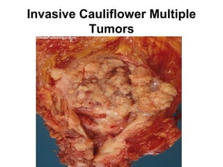 Invasive Cauliflower Multiple
Tumors
 