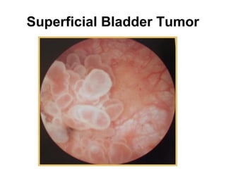Superficial Bladder Tumor
 