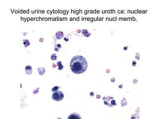 Voided urine cytology high grade uroth ca: nuclear
hyperchromatism and irregular nucl memb.
 