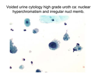 Voided urine cytology high grade uroth ca: nuclear
hyperchromatism and irregular nucl memb.
 
