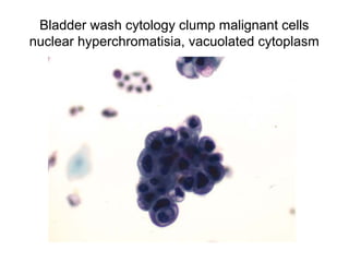 Bladder wash cytology clump malignant cells
nuclear hyperchromatisia, vacuolated cytoplasm
 