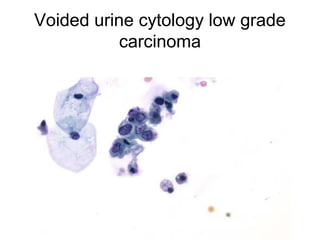 Voided urine cytology low grade
carcinoma
 