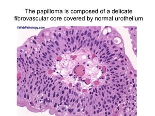 The papilloma is composed of a delicate
fibrovascular core covered by normal urothelium
 