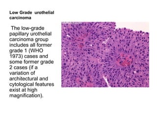 Low Grade urothelial
carcinoma
The low-grade
papillary urothelial
carcinoma group
includes all former
grade 1 (WHO
1973) cases and
some former grade
2 cases (if a
variation of
architectural and
cytological features
exist at high
magnification).
 