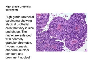 High grade Urothelial
carcinoma
High grade urothelial
carcinoma showing
atypical urothelial
cells that vary in size
and shape. The
nuclei are enlarged,
with coarsely
granular chromatin,
hyperchromasia,
abnormal nuclear
contours and
prominent nucleoli
 