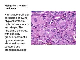 High grade Urothelial
carcinoma
High grade urothelial
carcinoma showing
atypical urothelial
cells that vary in size
and shape. The
nuclei are enlarged,
with coarsely
granular chromatin,
hyperchromasia,
abnormal nuclear
contours and
prominent nucleoli
 