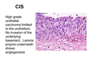 CIS
High grade
urothelial
carcinoma limitted
to the urothelium.
No invasion of the
underlying
basement.. Lamnia
propria underneath
shows
angiogenesis
 
