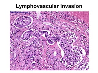 Lymphovascular invasion
 
