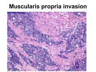 Muscularis propria invasion
 