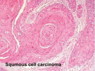 Squmous cell carcinoma
 
