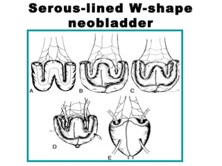 Serous-lined W-shape
neobladder
 
