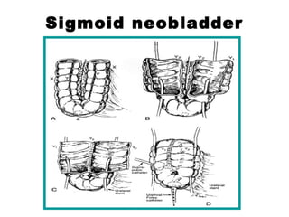 Sigmoid neobladder
 
