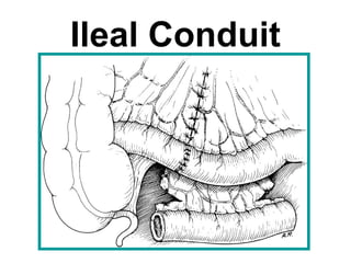 Ileal Conduit
 