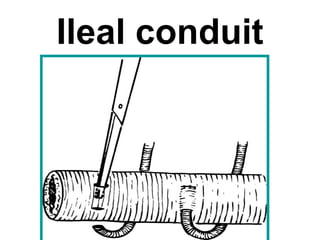 Ileal conduit
 