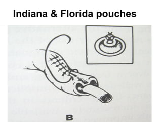 Indiana & Florida pouches
 