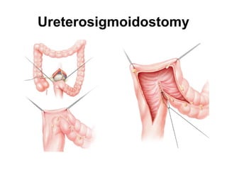 Ureterosigmoidostomy
 