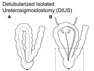 Detubularized Isolated
Ureterosigmoidostomy (DIUS)
 