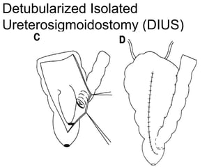 Detubularized Isolated
Ureterosigmoidostomy (DIUS)
 