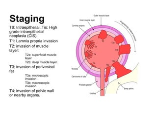 Staging
T0: Intraepithelial, Tis: High
grade intraepithelial
neoplasia (CIS).
T1: Lamnia propria invasion
T2: invasion of muscle
layer:
T2a: superficial muscle
layer
T2b: deep muscle layer.
T3: invasion of perivesical
fat
T3a: microscopic
invasion
T3b: macroscopic
invasion.
T4: invasion of pelvic wall
or nearby organs.
 
