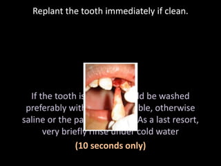 Replant the tooth immediately if clean. 
If the tooth is dirty, it should be washed 
preferably with milk if available, otherwise 
saline or the patient’s saliva. As a last resort, 
very briefly rinse under cold water 
(10 seconds only) 
 