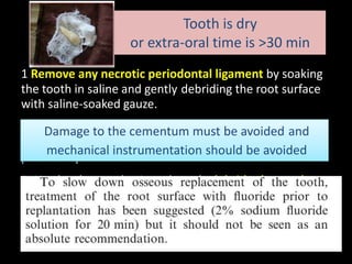 Tooth is dry 
or extra-oral time is >30 min 
1 Remove any necrotic periodontal ligament by soaking 
the tooth in saline and gently debriding the root surface 
with saline-soaked gauze. 
2 The Damage tooth should to the also cementum be soaked must in 2% be avoided sodium fluoride 
and 
for 20 min. It is essential that the tooth be rehydrated 
mechanical instrumentation should be avoided 
prior to replantation. 
3 Give local anaesthesia and gently debride the tooth 
socket with saline to remove the blood clot; do not 
curette the bone or remaining ligament. 
4 Replant the tooth gently with finger pressure. 
 