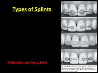 Types of Splints 
(McDonald's and Avery, 2011) 
 