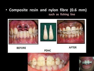 • Composite resin and nylon fibre (0.6 mm) 
such as fishing line 
 
