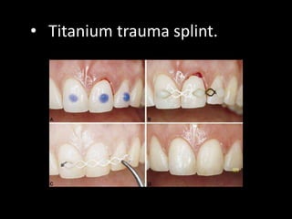 • Titanium trauma splint. 
 