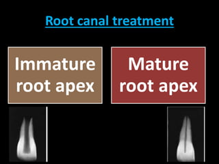Root canal treatment 
Immature 
root apex 
Mature 
root apex 
 