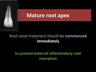 Mature root apex 
Root canal treatment should be commenced 
immediately 
to prevent external inflammatory root 
resorption 
 