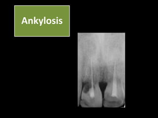 Ankylosis 
 