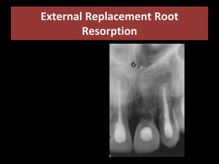 External Replacement Root 
Resorption 
 