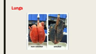 Lungs
 