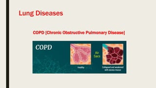 Lung Diseases
COPD [Chronic Obstructive Pulmonary Disease]
 