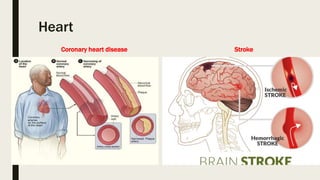 Heart
Coronary heart disease Stroke
 