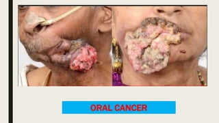 ORAL CANCER
 
