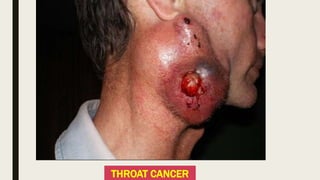 THROAT CANCER
 