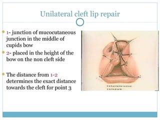 Unilateral cleft lip repair
1- junction of mucocutaneous
junction in the middle of
cupids bow
2- placed in the height of the
bow on the non cleft side
The distance from 1-2
determines the exact distance
towards the cleft for point 3
 