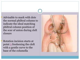 Advisable to mark with dots
the normal philtral column to
indicate the ideal matching
philtral column position of
the scar of union during cleft
closure
Rotation incision starts at
point 3 freshening the cleft
with a gentle curve to the
base of the columella
 