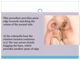 This procedure provides 4mm
edge towards matching the
10mm of the normal side
At the columella base the
rotation incision continues
2/3rd
the way across closely
hugging the base, which
provides another 3mm of edge
 