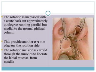 The rotation is increased with
a acute back cut approximately
90 degree running parallel but
medial to the normal philtral
column
This provide another 2-3 mm
edge on the rotation side
The rotation incision is carried
through the muscles to liberate
the labial mucosa from
maxilla
 