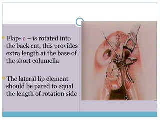 Flap- c – is rotated into
the back cut, this provides
extra length at the base of
the short columella
The lateral lip element
should be pared to equal
the length of rotation side
 