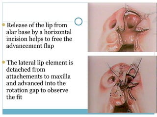 Release of the lip from
alar base by a horizontal
incision helps to free the
advancement flap
The lateral lip element is
detached from
attachements to maxilla
and advanced into the
rotation gap to observe
the fit
 