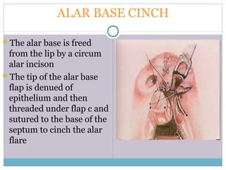 ALAR BASE CINCH
The alar base is freed
from the lip by a circum
alar incison
The tip of the alar base
flap is denued of
epithelium and then
threaded under flap c and
sutured to the base of the
septum to cinch the alar
flare
 