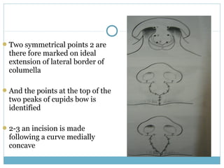 Two symmetrical points 2 are
there fore marked on ideal
extension of lateral border of
columella
And the points at the top of the
two peaks of cupids bow is
identified
2-3 an incision is made
following a curve medially
concave
 