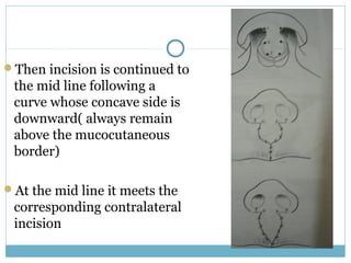 Then incision is continued to
the mid line following a
curve whose concave side is
downward( always remain
above the mucocutaneous
border)
At the mid line it meets the
corresponding contralateral
incision
 